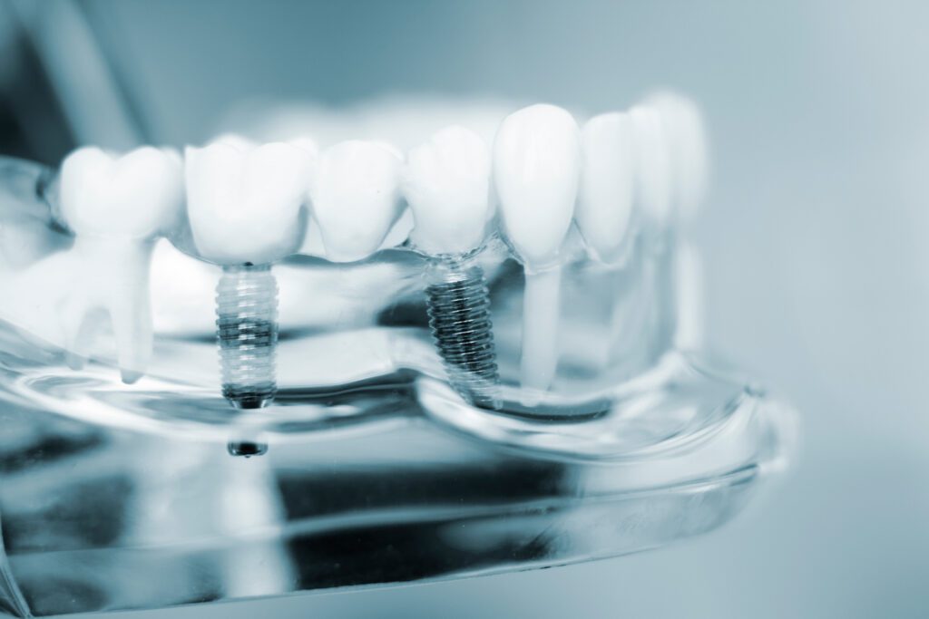 dental implants in Alexandria