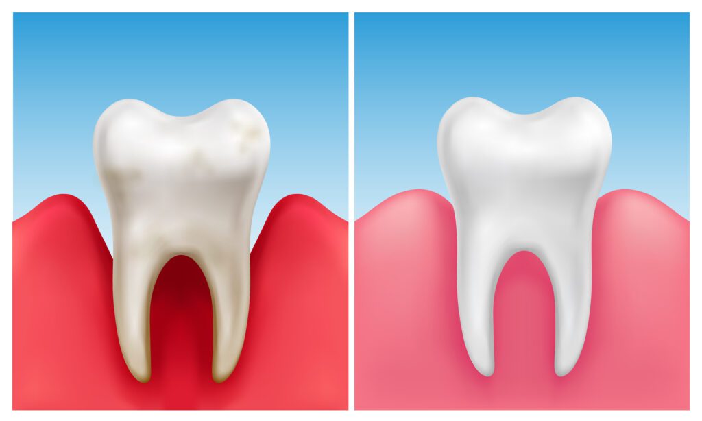 gum disease in Waldorf