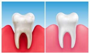 gum recession in Waldorf